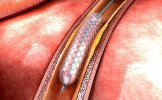 Gyrus buys LivaNova heart valve business for €60m